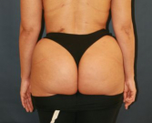 Feel Beautiful - Fat to Buttocks - After Photo